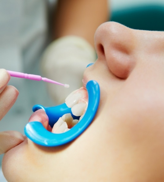Close up of childs mouth during fluoride treatment