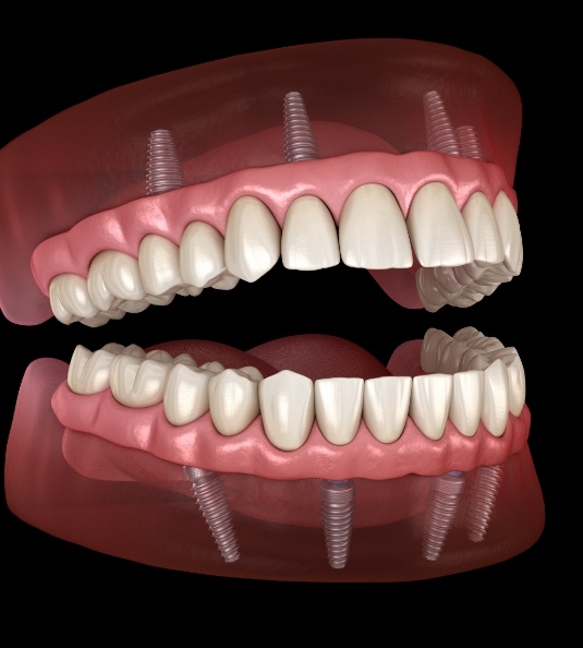 Illustration of All on 4 in Carrollton for both arches