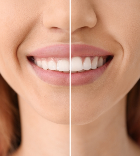 Smile before and after gum recontouring