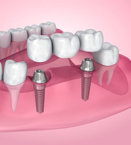 Illustration of dental bridge being attached to dental implants