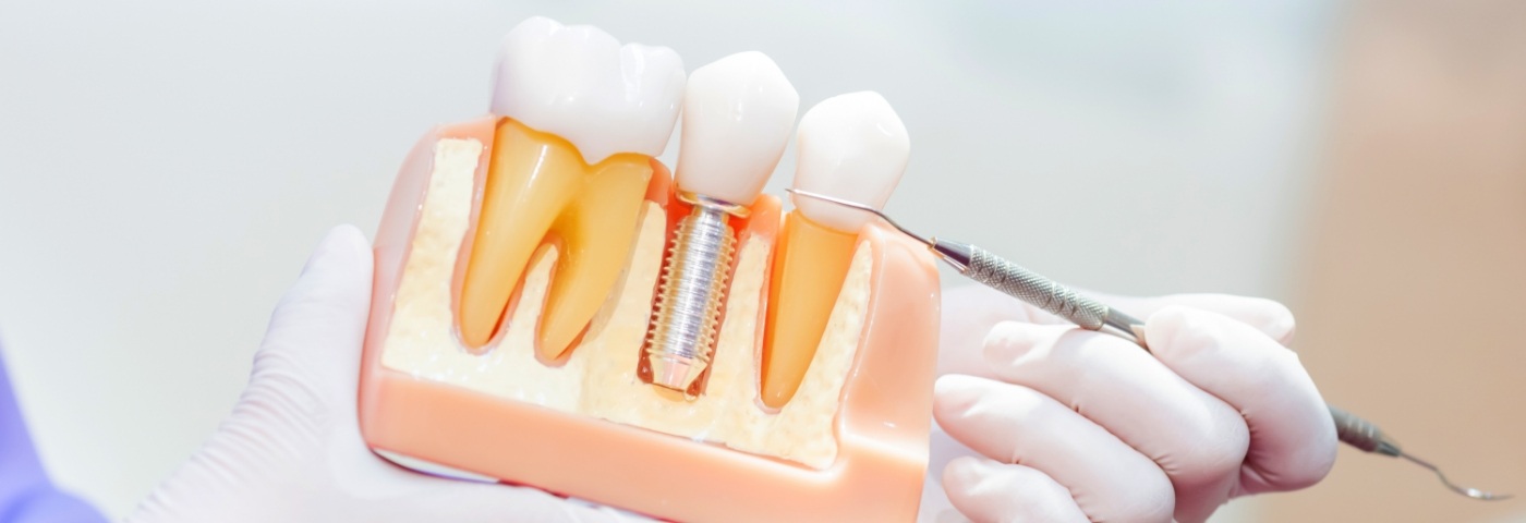 Gloved hands pointing to model of dental implant