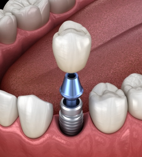 Illustration of dental implant and crown being inserted into jaw