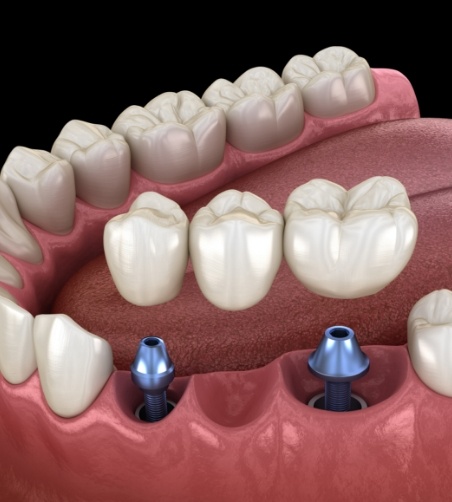 Dental bridge being attached to two dental implants