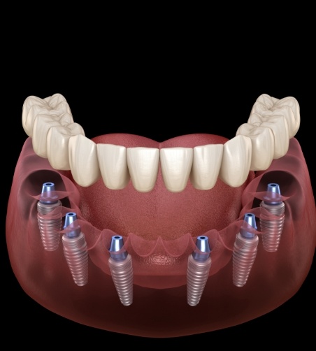 Illustration of dentures being attached to dental implants