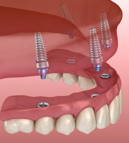 Illustration of All on 4 for upper arch