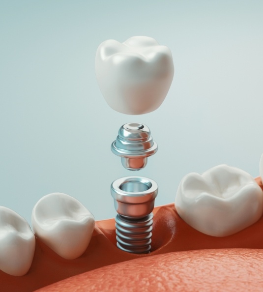 Illustration of dental implant crown and abutment