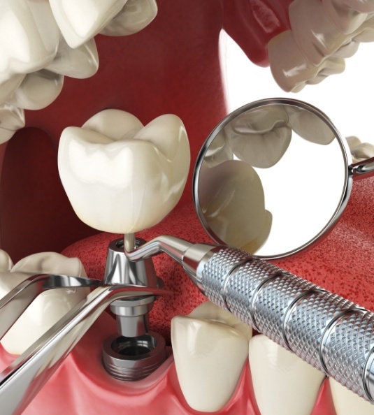 Illustration of crown being attached to dental implant