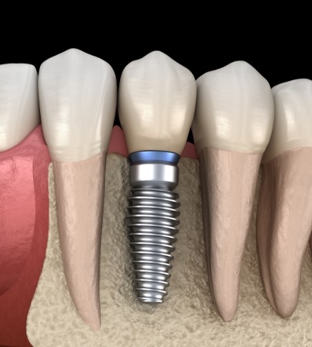 Illustration of dental implant integrated to jaw