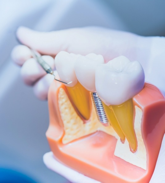 Holding dental implant model and pointing to it with dental instrument