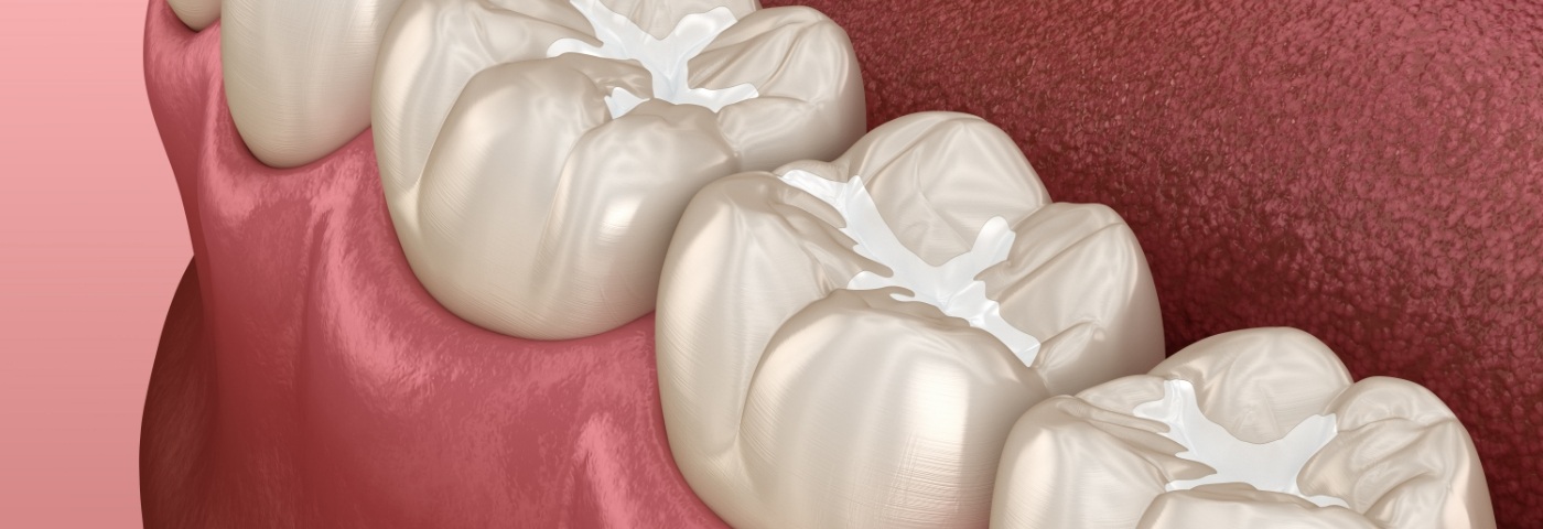 Illustration of teeth with dental sealants in Carrollton