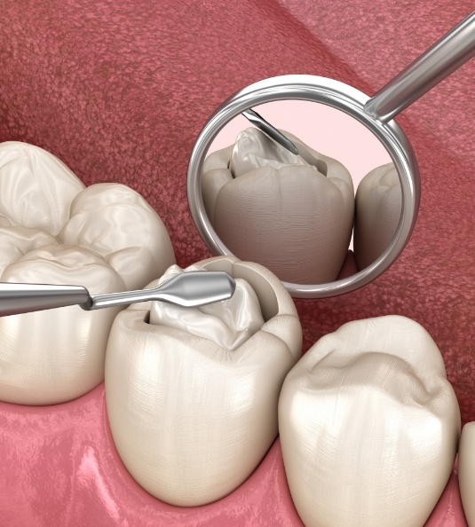 Illustration of a dental sealant being placed