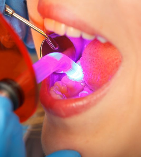 Light for direct bonding and dental mirror in mouth