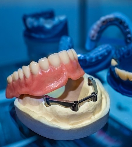 Dentures sitting on top of model of dental implants