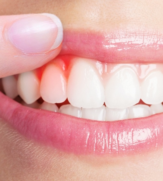 Woman raising lip to show signs of gum disease in Carrollton