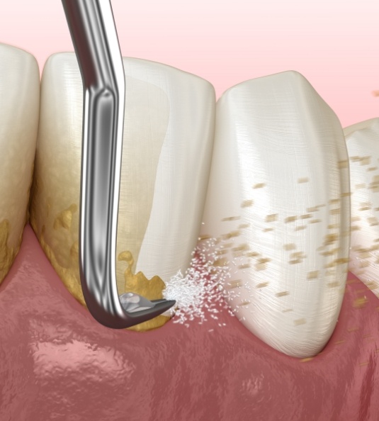 Illustration of scaling and root planing for lower arch