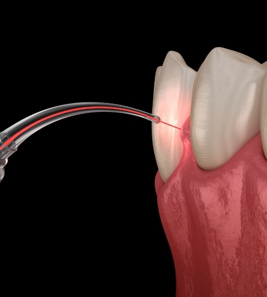 Illustration of laser treating gums