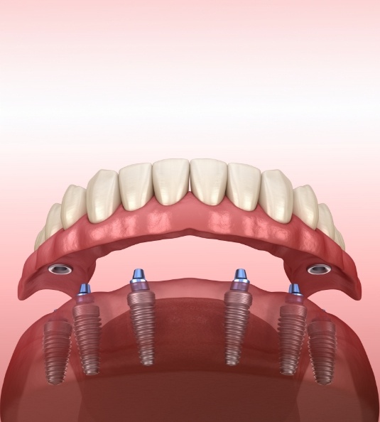 Illustration of dentures being attached to dental implants