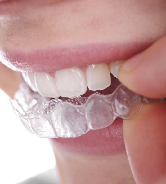 Close up of teeth and Invisalign aligner