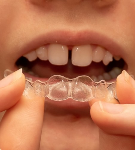 Person with gapped front tooth about to wear clear aligner