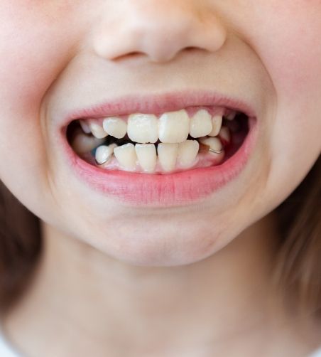 Close up of patient with an open bite