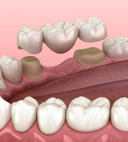 Illustration of dental bridge being placed on teeth