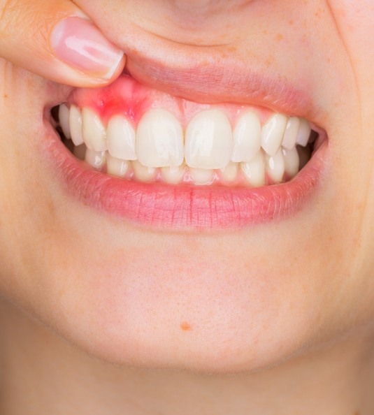 Pulling up lip to show inflamed gums