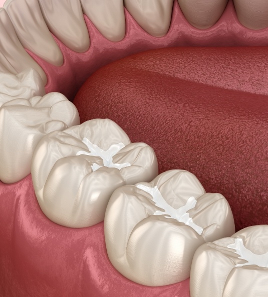 Illustration of teeth with tooth colored fillings