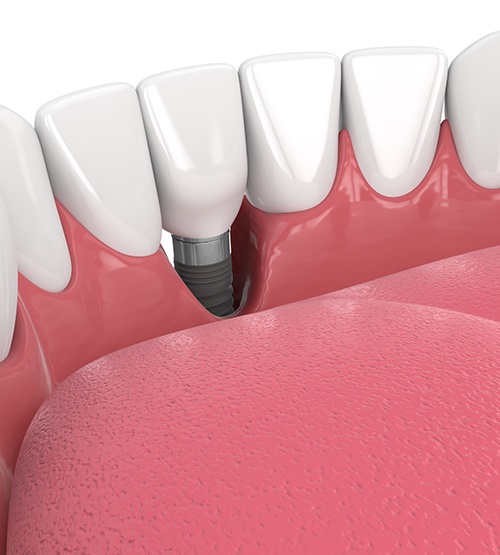 Illustration of bone loss around failed dental implant in Carrollton