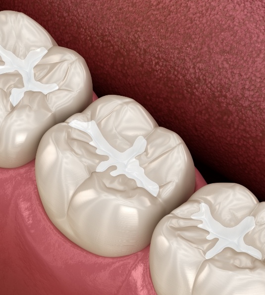 Illustration of multiple teeth with tooth colored fillings in Carrollton