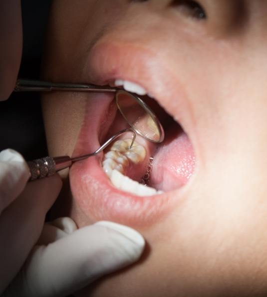 Examining teeth with mirror and exploratory tool