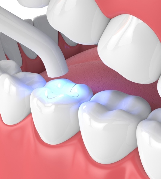 Illustration of tooth colored fillings being hardened in place