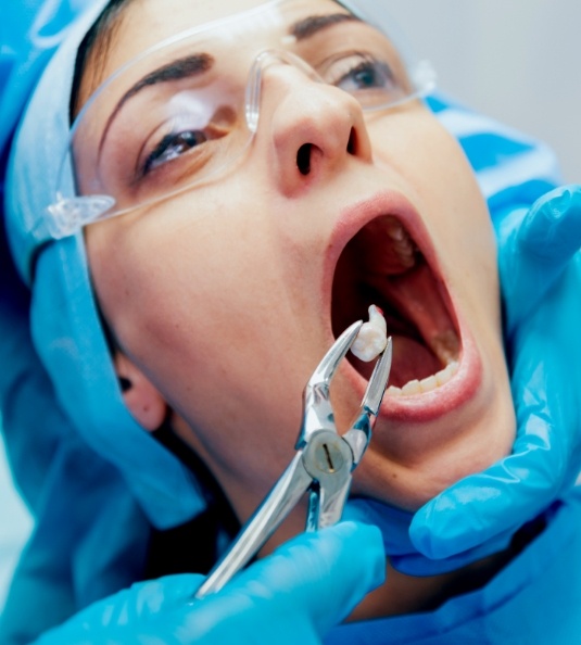 Patient holding mouth open and forceps holding an extracted tooth