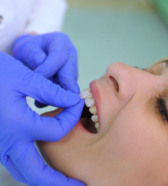 Placing veneers on female patients teeth