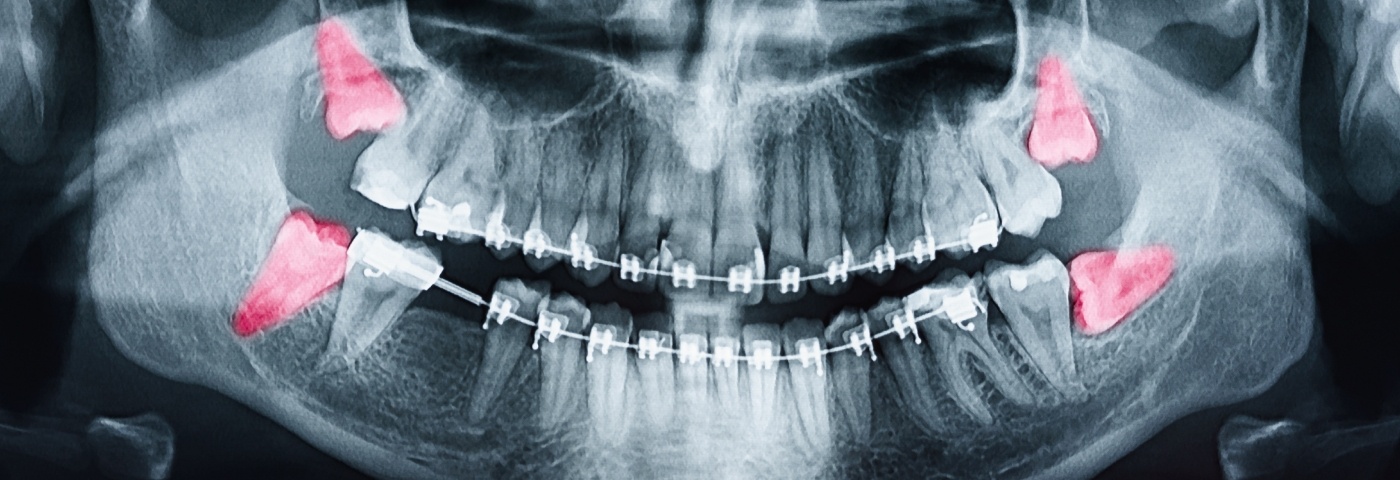 X ray showing impacted wisdom teeth in Carrollton