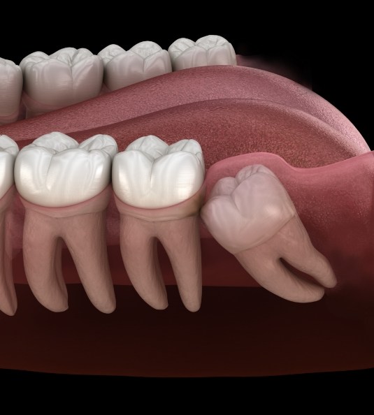 Illustration of impacted wisdom tooth