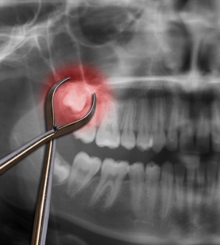 X ray showing an impacted wisdom tooth