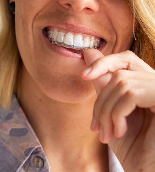 Woman wearing Invisalign trays